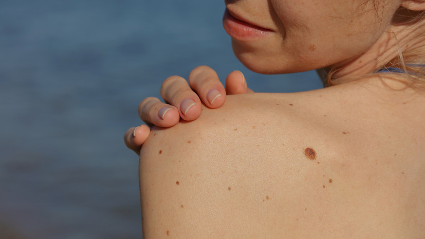 Врач Сирмайс посоветовала не загорать людям с родинками