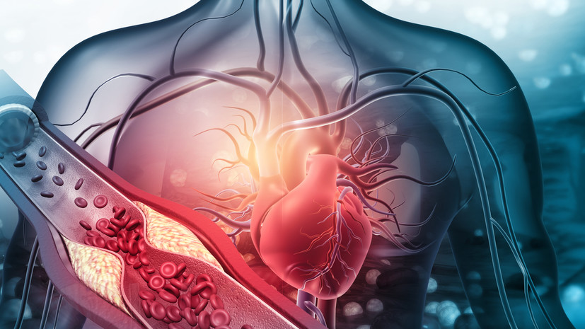 Врач Фомичёва: атеросклероз медленно разрушает организм