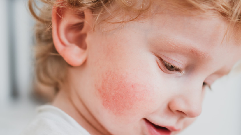 Врач Логина объяснила, как определяется аллергия на холод