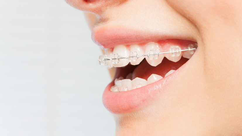 Стоматолог Балакирева назвала опасным самостоятельное снятие брекетов