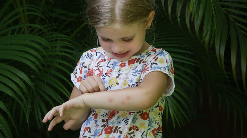 Иммунолог Логина: аллергии на укус комаров в большей степени подвержены дети