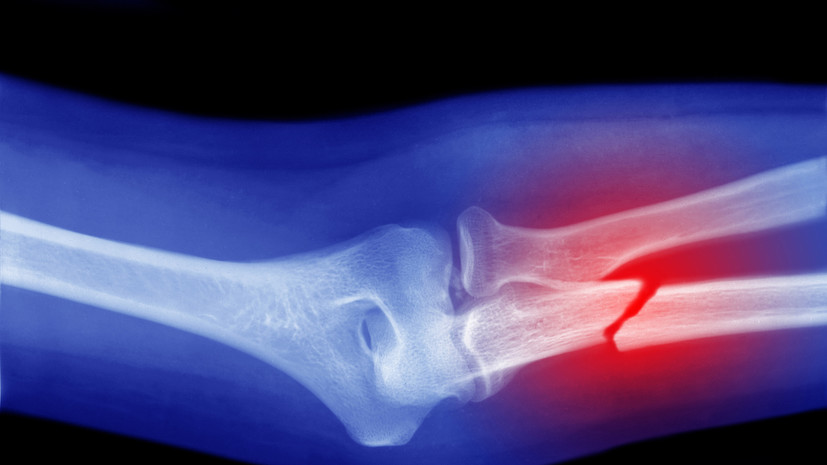 Врач Бештоев: в случае перелома отёк и гематома появляются очень быстро