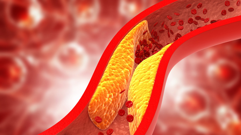 Кардиолог Паукова: холестериновые бляшки образуются из-за высокого давления