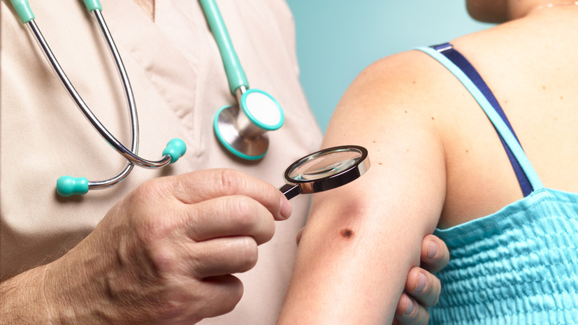 Онколог Старостин посоветовал обратиться к врачу при изменении размера родинки