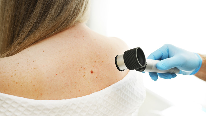 Онколог Чанг: осенью растёт число обращений пациентов с меланомой
