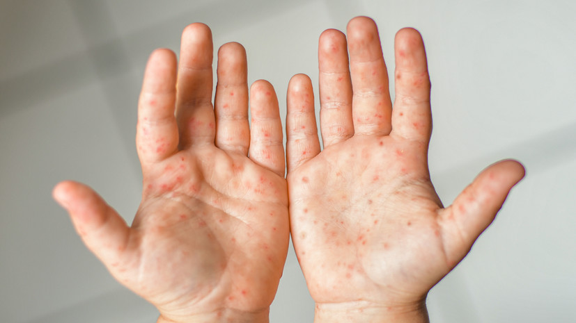 Вирусолог Викулов: коксаки хорошо известен российским специалистам