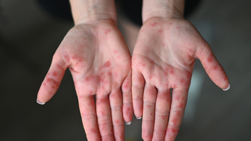 Отель Турции опроверг данные о якобы случаях заражения вирусом Коксаки