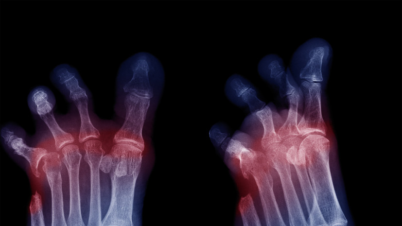 Врач заявил о необходимости применения инновационных методов лечения ишемии ног