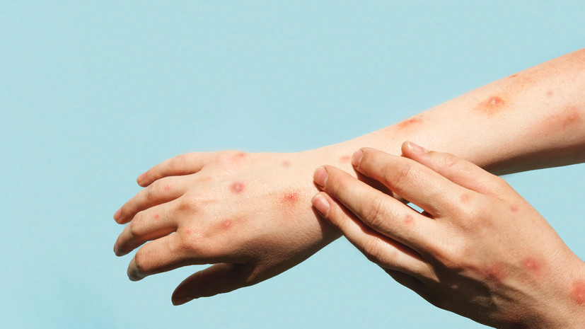 Врач Чернышова: вакцинация поможет защититься от ветрянки