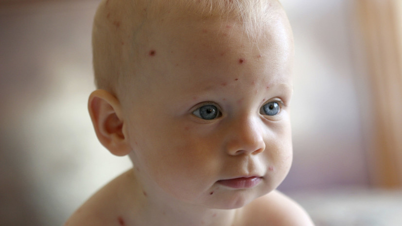 Россиян предупреждают о сезонном росте заболеваемости ветрянкой