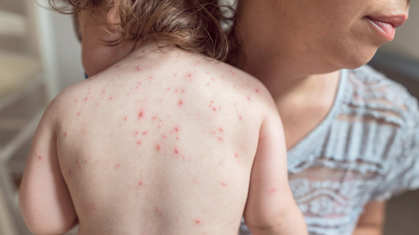 Врач Прокофьев: повторных случаев заболевания ветрянкой практически не бывает