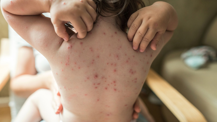 Россиянам рассказали о вероятности повторного заражения ветрянкой