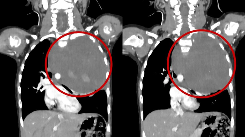 Врачи РДКБ Минздрава России удалили девочке опухоль размером со страусиное яйцо