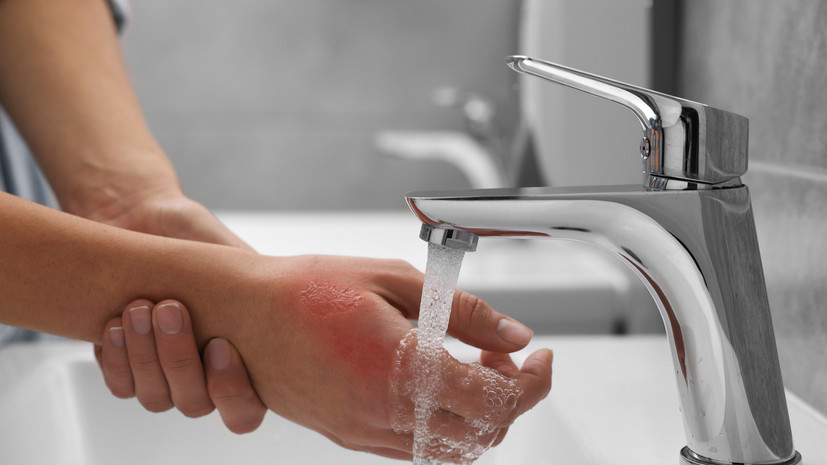 Хирург Сачков назвал ошибкой использование народных средств при ожогах