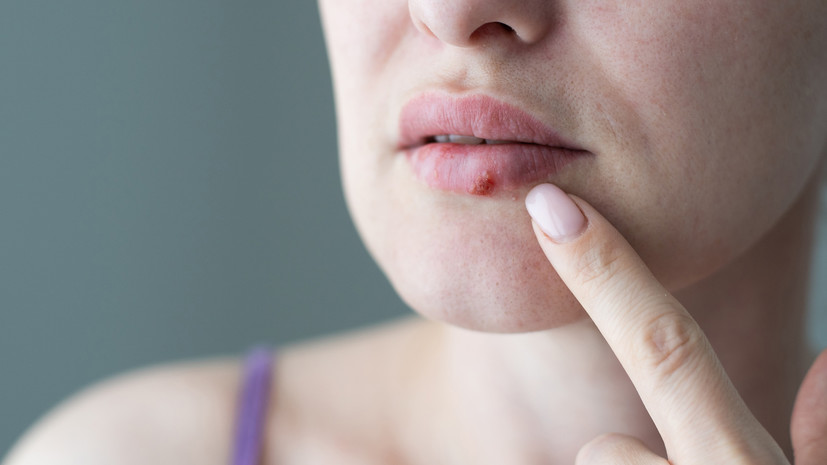 Профессор Волчкова: холод может спровоцировать появление герпеса