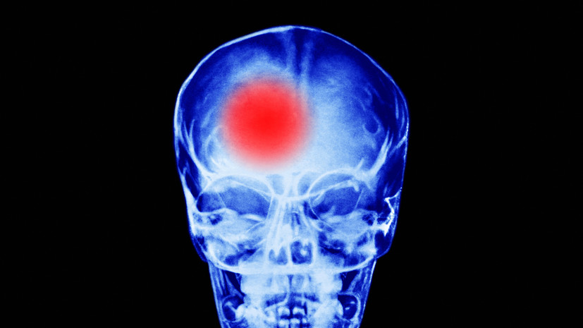 Невролог Демьяновская: улыбка становится асимметричной при инсульте