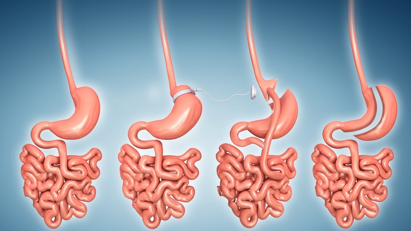 Пластический хирург Борисенко: на операцию по уменьшению желудка берут не всех