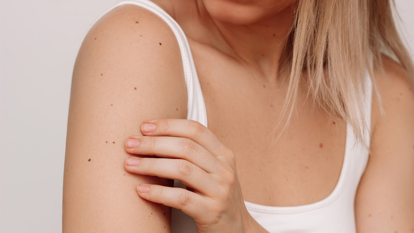 Врач Скорогудаева предостерегла от самостоятельного удаления родинок