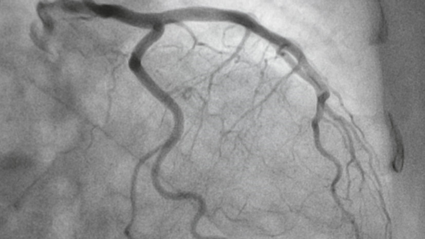 Врач Платонова: ангиографию стоит делать только после перенесённого инфаркта