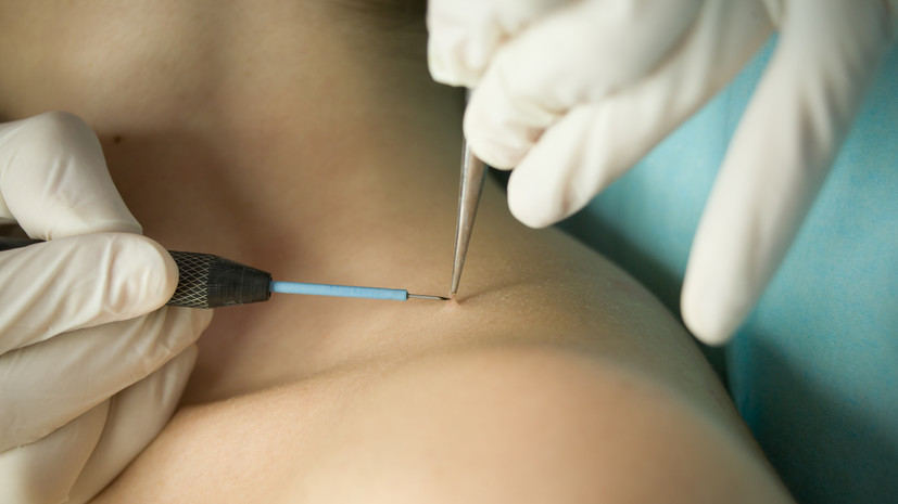 Онколог Черёмушкин предостерёг от самостоятельного удаления папиллом