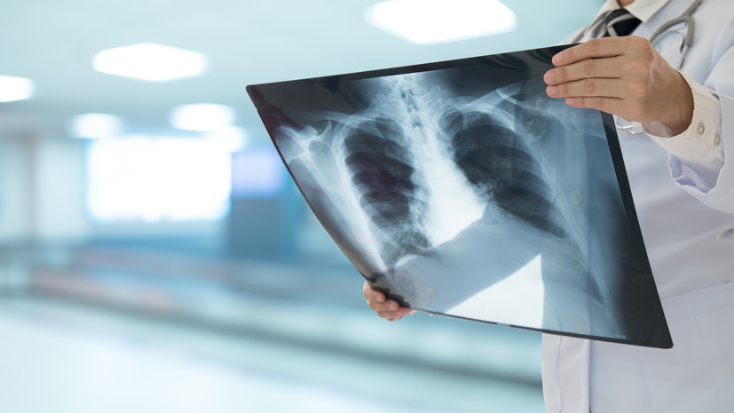 В России на 100 тысяч населения приходится 629 случаев внебольничной пневмонии