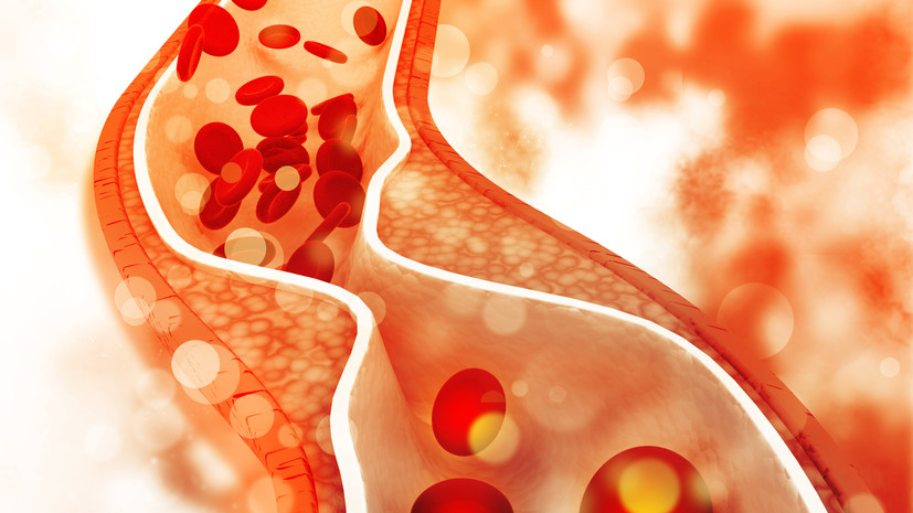 Физиолог Калюжин: риск тромбоза растёт при ожирении