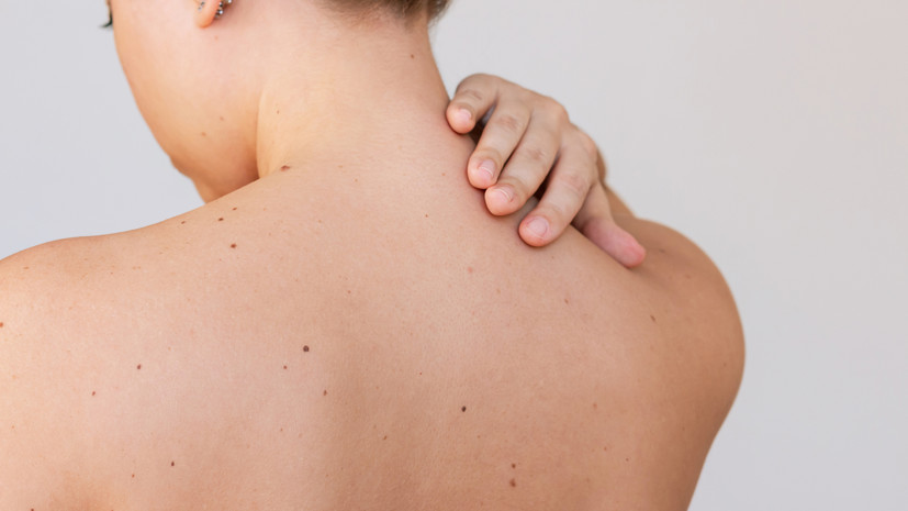 Онколог Орлова посоветовала следить за состоянием родинок