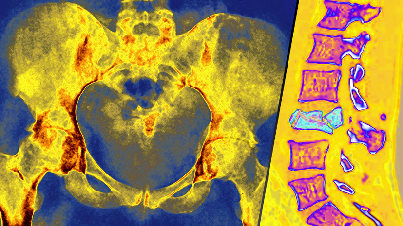 «Зависит от степени дефицита»: эксперты объяснили, как правильно принимать витамин D3