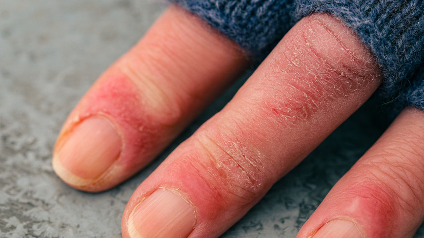 Фельдшер Карасёва рассказала о первой помощи при обморожении