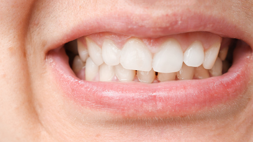 Стоматолог Дмитрова: на исправление прикуса у взрослых может потребоваться три года