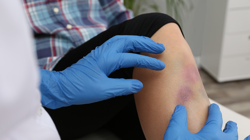 Невролог Демьяновская: простой ушиб может оказаться скрытым переломом