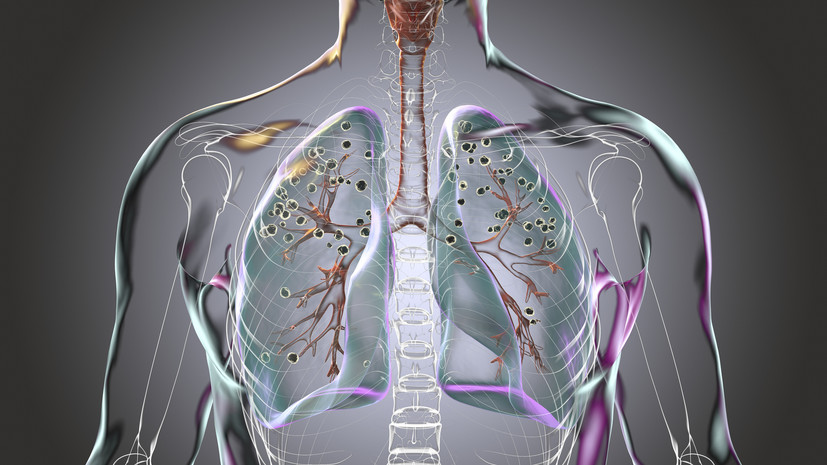 Fox News сообщил о первом случае силикоза у рабочего в Массачусетсе