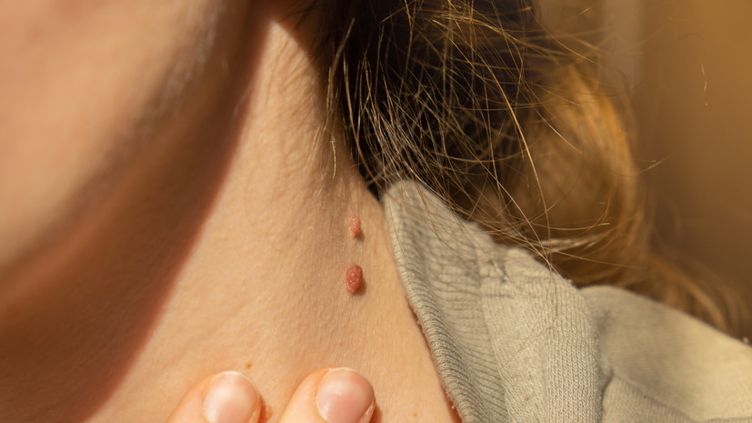 Онколог Чулкова рассказала о причинах превращения папилломы в раковую опухоль