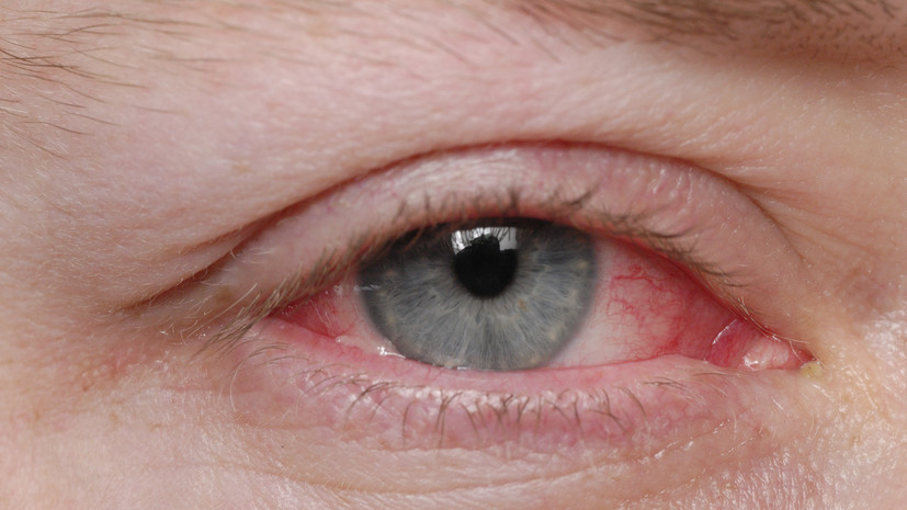 Офтальмолог Зарубин: зимний воздух может спровоцировать конъюнктивит