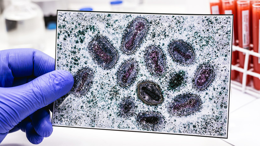 В Домодедовской больнице подтвердили случай оспы обезьян у пациента