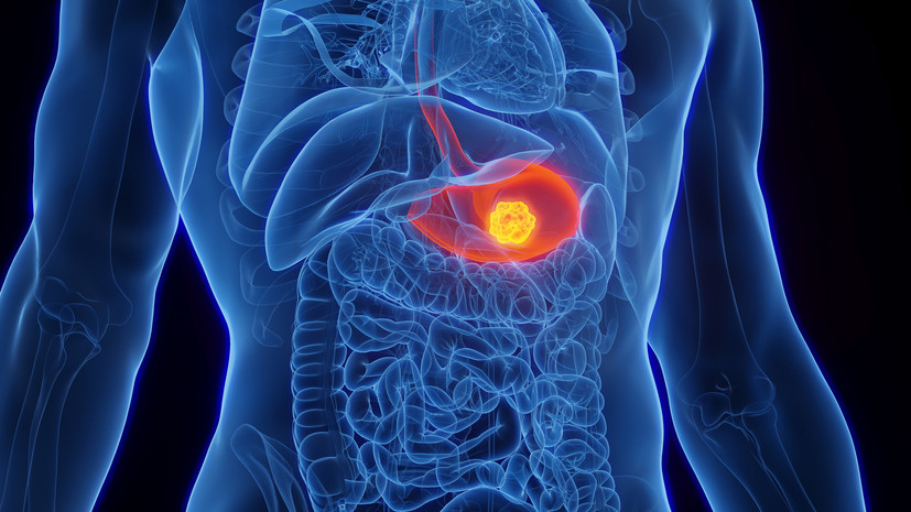 Гастроэнтеролог: для профилактики рака нужно учитывать возраст и наследственность