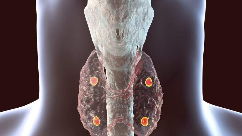 Эндокринолог: нарушения в работе околощитовидных желёз опасны для здоровья