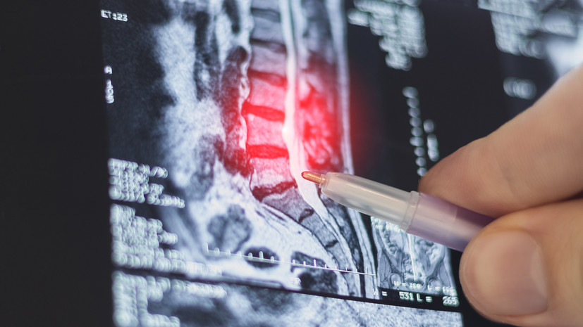 Нейрохирург Есин назвал межпозвонковую грыжу типичным осложнением остеохондроза