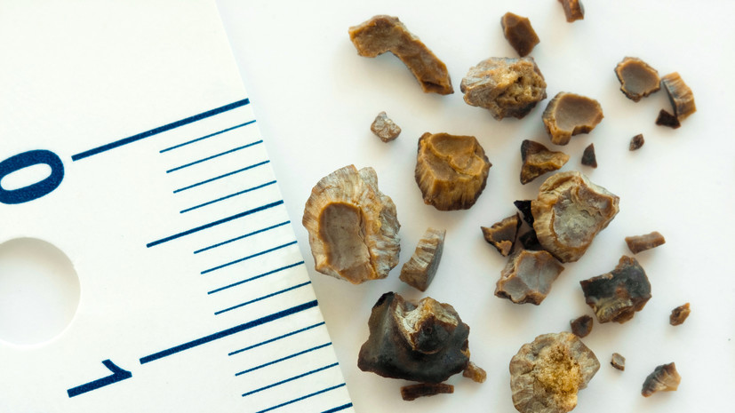 Уролог Сыркин: камни в почках могут вызвать серьёзные осложнения