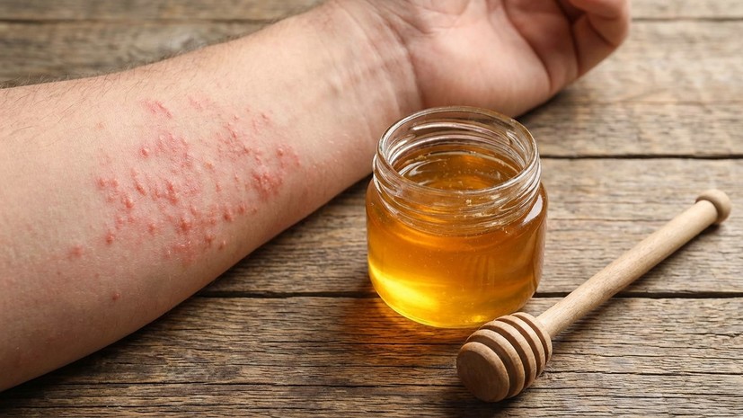 Терапевт Алексеева: мёд усиливает симптомы аллергии