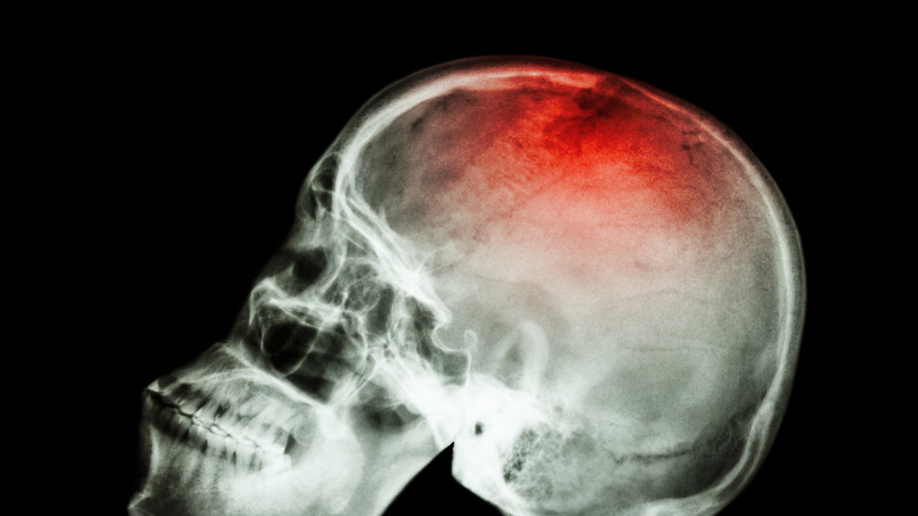 Врач Шарипова: риск инсульта максимально высок после 60 лет