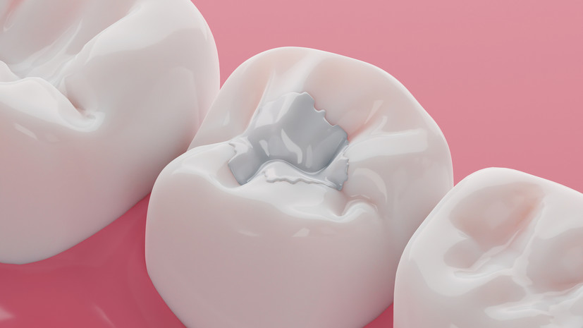 Врач Халилбеков: большая пломба в ослабленном зубе повышает риск перелома