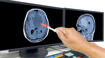 Онколог&nbsp; Черёмушкин рассказал о симптомах глиобластомы