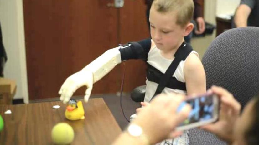 Инженеры вернули ребёнку руку с помощью 3D-принтера и деталей стоимостью $350