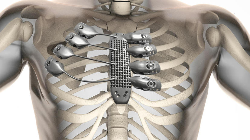 В Испании провели первую в мире операцию по пересадке рёбер, напечатанных на 3D-принтере