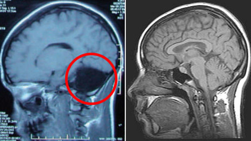 В Китае врачи обнаружили женщину без части мозга